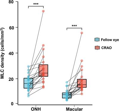 Changes in macrophage-like cells characterized by en face optical coherence tomography after retinal stroke